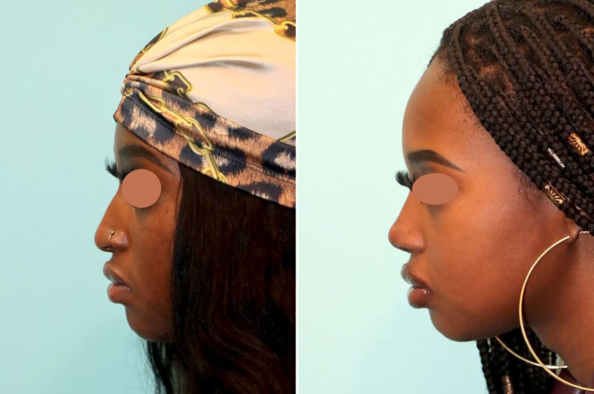 Before and after Rhinoplasty by Dr. Shervin Naderi, Patient 25813