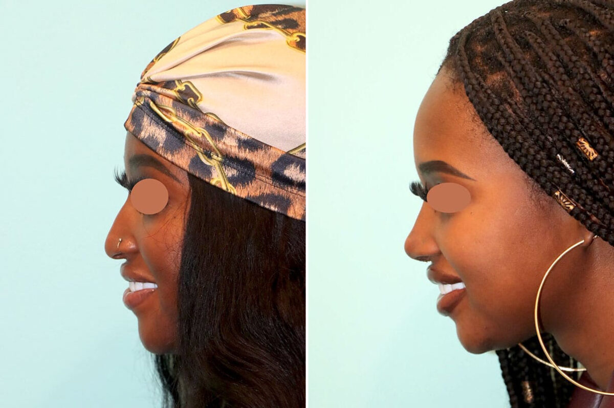 Before and after Rhinoplasty by Dr. Shervin Naderi, Patient 25813