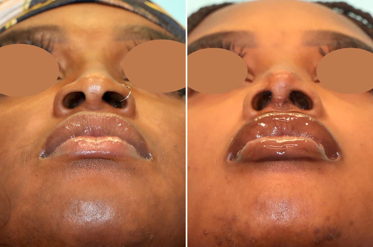 Before and after Rhinoplasty by Dr. Shervin Naderi, Patient 25813