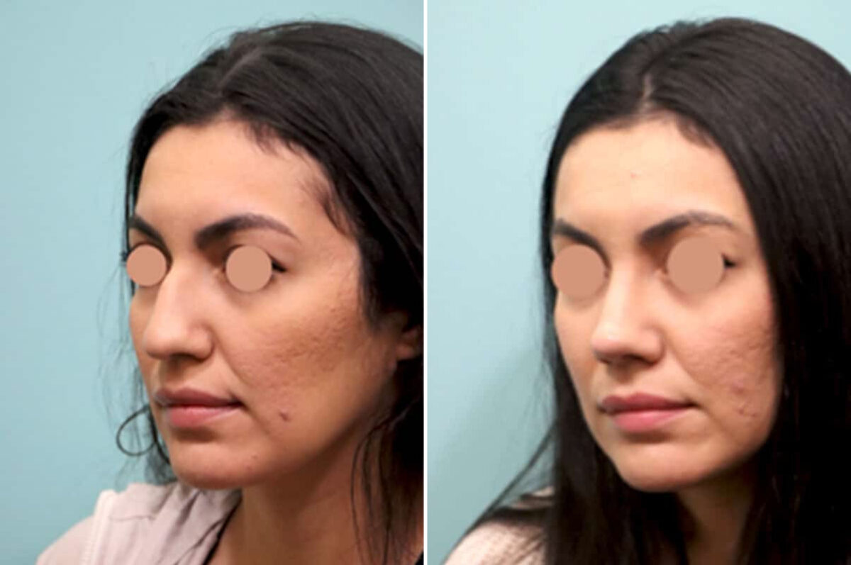 Before and after Rhinoplasty by Dr. Shervin Naderi, Patient 25844