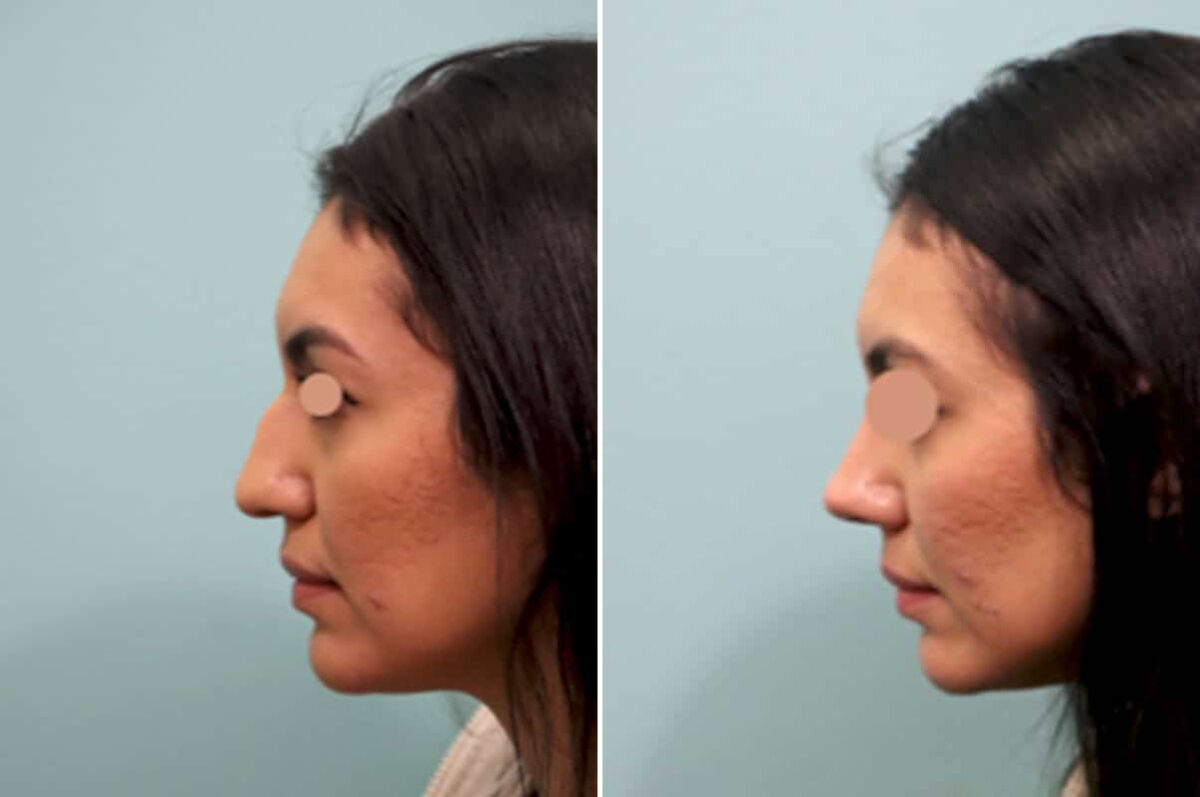 Before and after Rhinoplasty by Dr. Shervin Naderi, Patient 25844