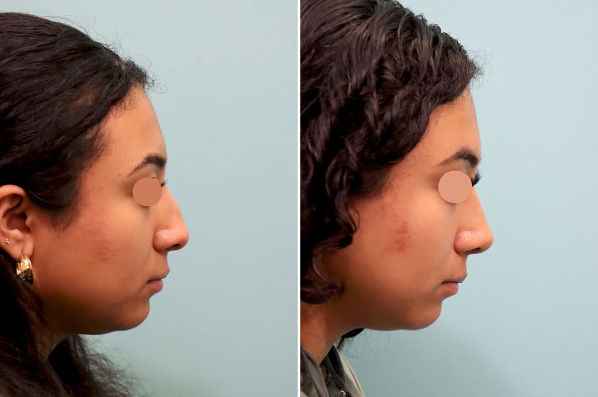 Before and after Rhinoplasty by Dr. Shervin Naderi, Patient 25866