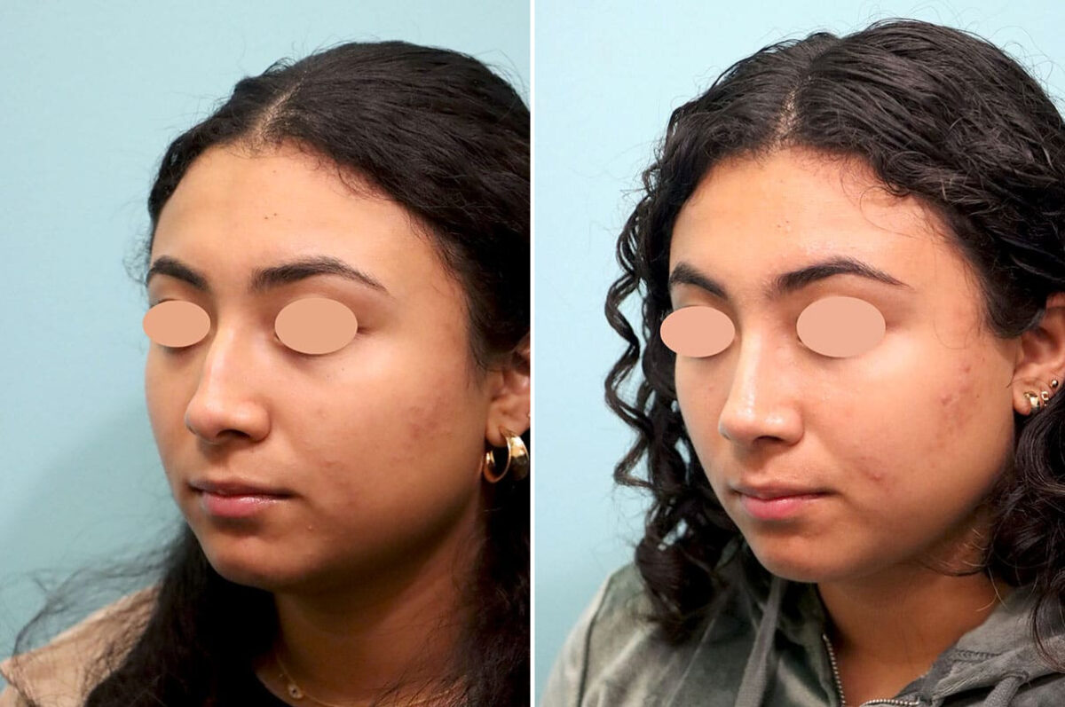 Before and after Rhinoplasty by Dr. Shervin Naderi, Patient 25866