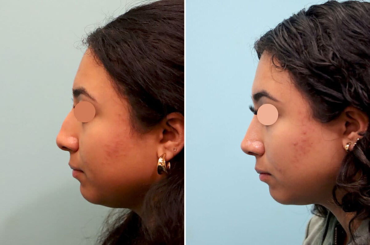 Before and after Rhinoplasty by Dr. Shervin Naderi, Patient 25866