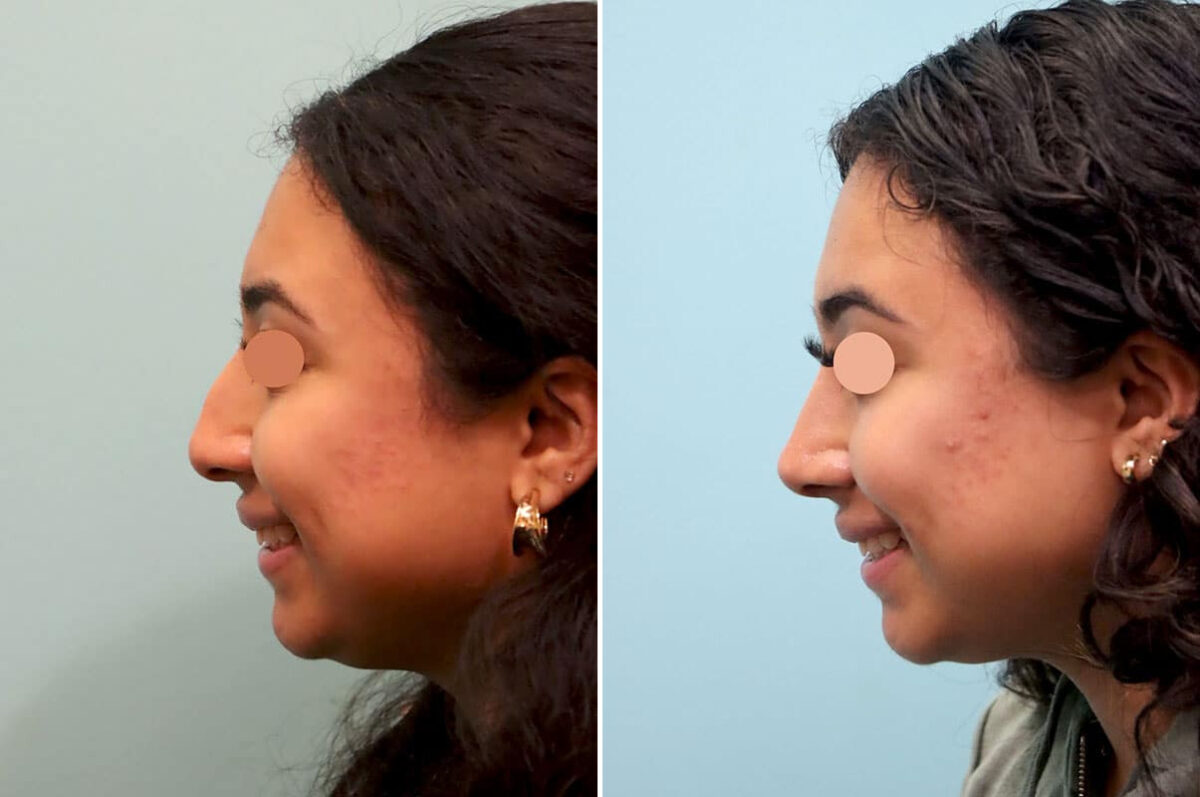 Before and after Rhinoplasty by Dr. Shervin Naderi, Patient 25866
