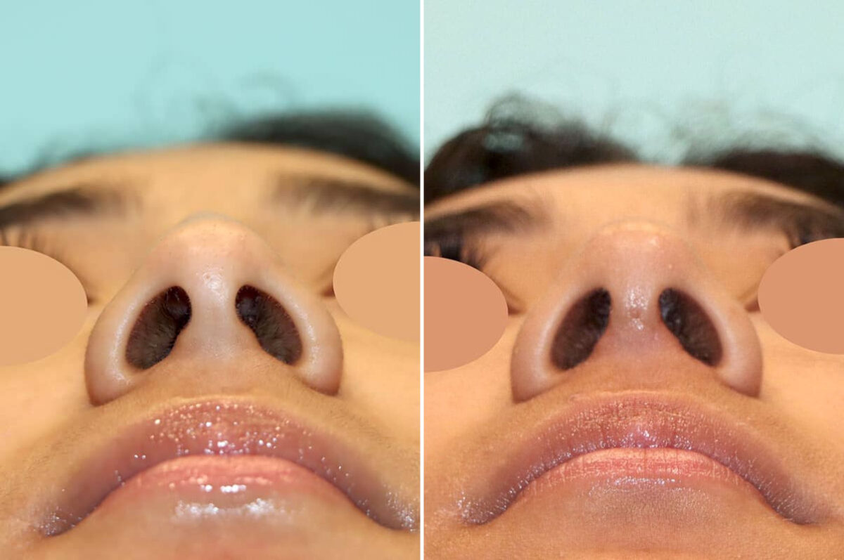 Before and after Rhinoplasty by Dr. Shervin Naderi, Patient 25866