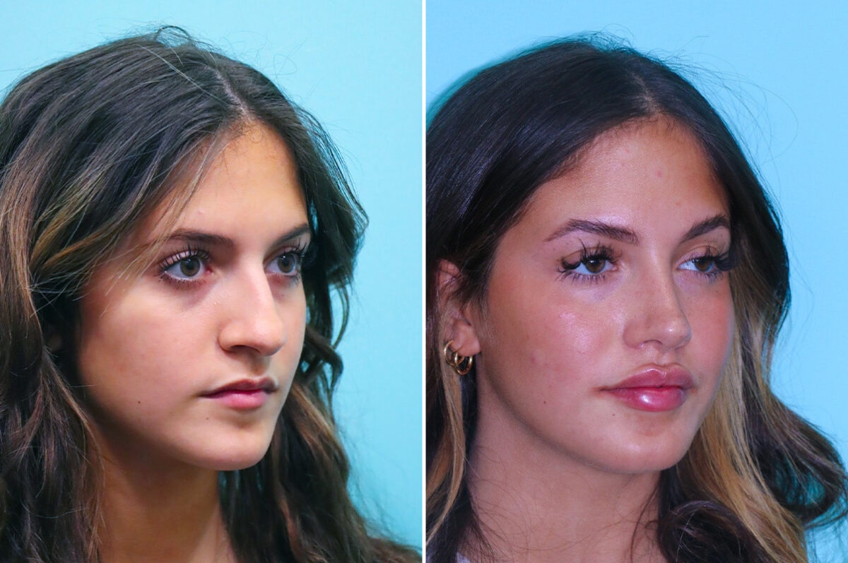 Before and after Rhinoplasty by Dr. Shervin Naderi, Patient 28087