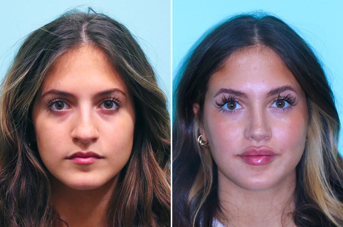 Before and after Rhinoplasty by Dr. Shervin Naderi, Patient 28087