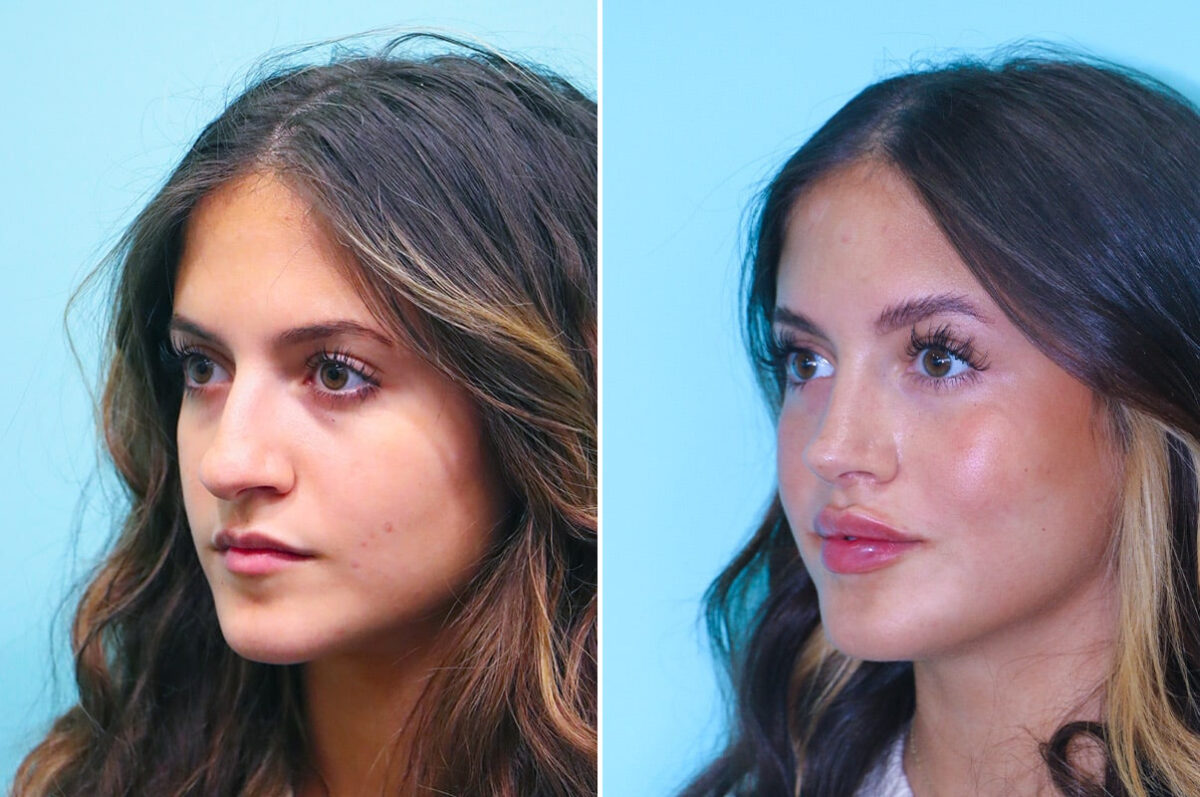 Before and after Rhinoplasty by Dr. Shervin Naderi, Patient 28087