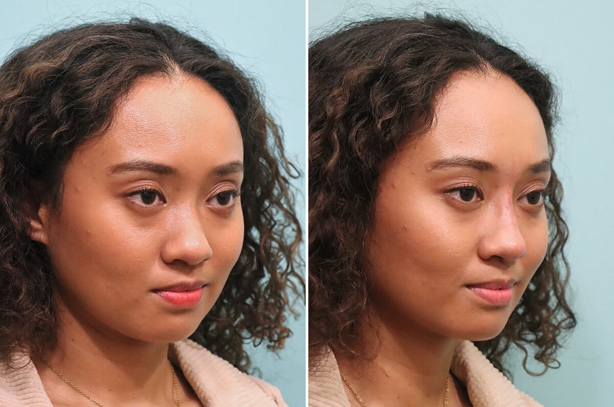 Before and after Non-Surgical Rhinoplasty by Dr. Shervin Naderi, Patient 28105