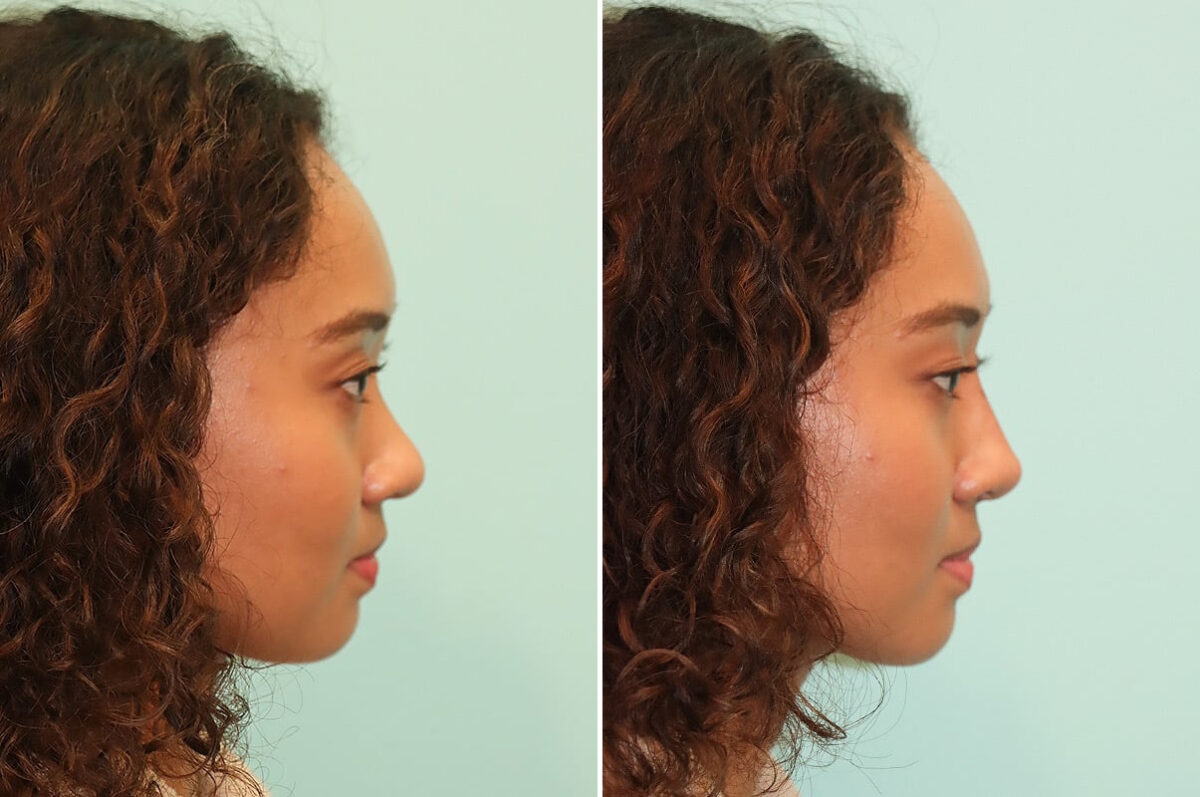 Before and after Non-Surgical Rhinoplasty by Dr. Shervin Naderi, Patient 28105