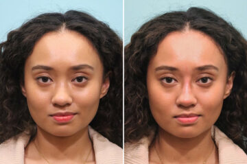 Before and after Non-Surgical Rhinoplasty by Dr. Shervin Naderi, Patient 28105