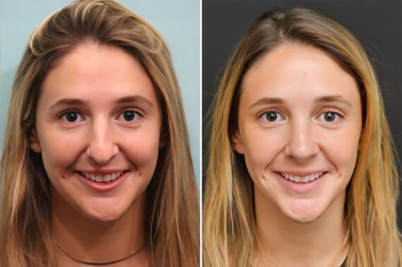 Before and after Rhinoplasty by Dr. Shervin Naderi, Patient 28165