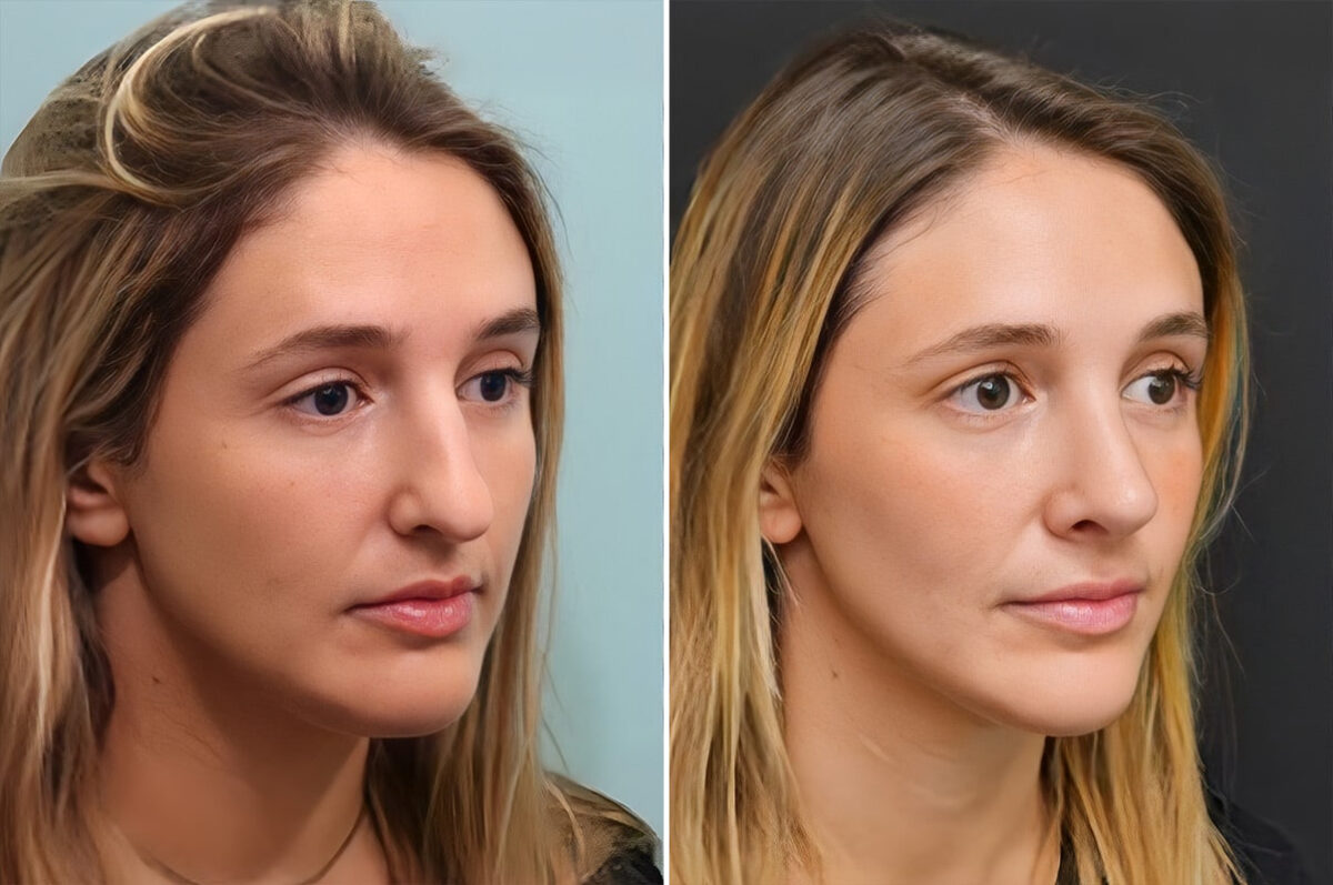 Before and after Rhinoplasty by Dr. Shervin Naderi, Patient 28165