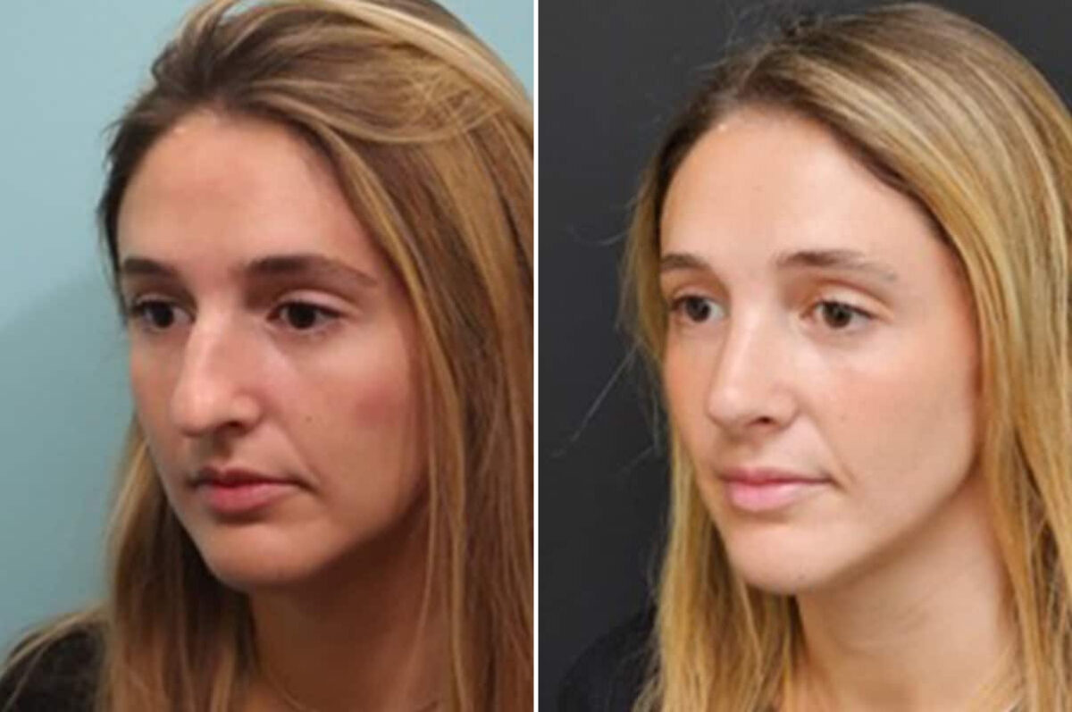 Before and after Rhinoplasty by Dr. Shervin Naderi, Patient 28165