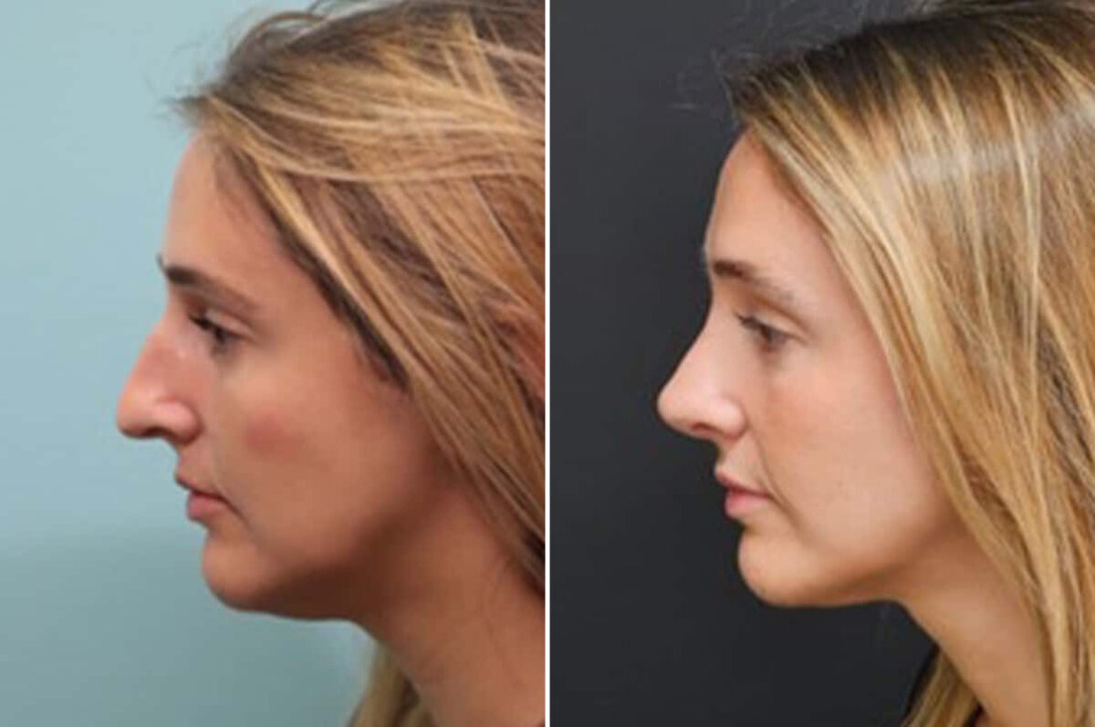 Before and after Rhinoplasty by Dr. Shervin Naderi, Patient 28165