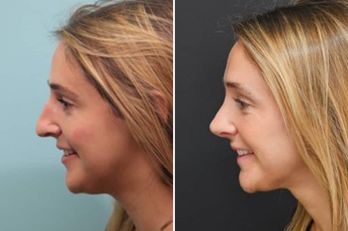 Before and after Rhinoplasty by Dr. Shervin Naderi, Patient 28165