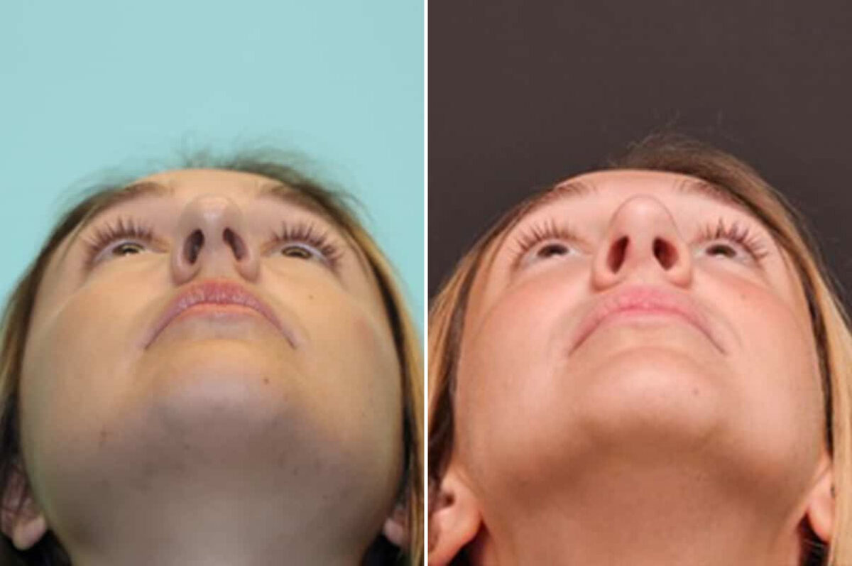Before and after Rhinoplasty by Dr. Shervin Naderi, Patient 28165