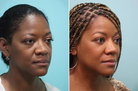 Before and after Rhinoplasty by Dr. Shervin Naderi, Patient 28191
