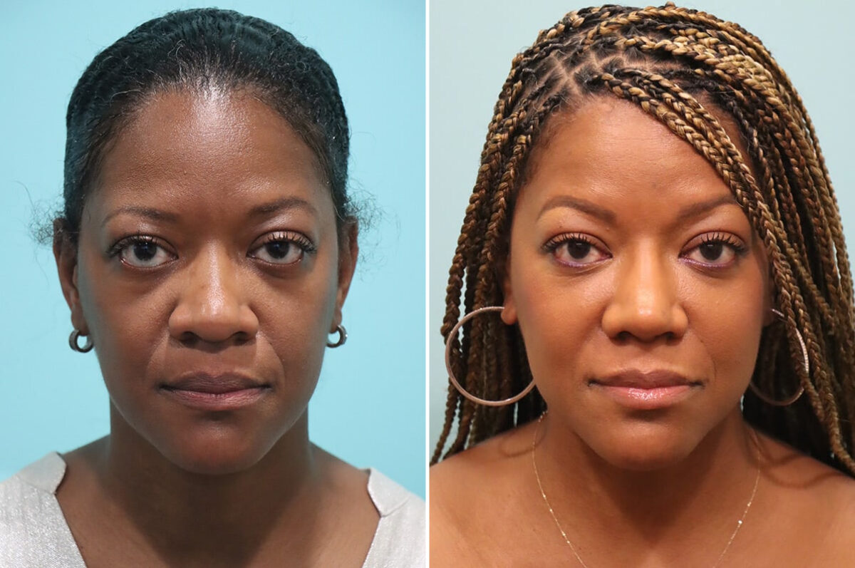 Before and after Rhinoplasty by Dr. Shervin Naderi, Patient 28191