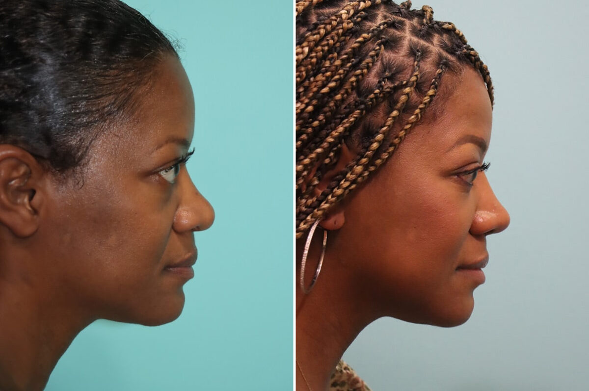 Before and after Rhinoplasty by Dr. Shervin Naderi, Patient 28191