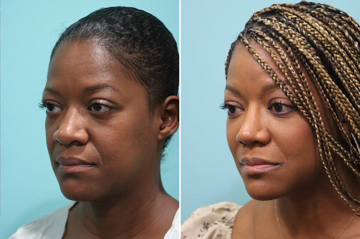 Before and after Rhinoplasty by Dr. Shervin Naderi, Patient 28191