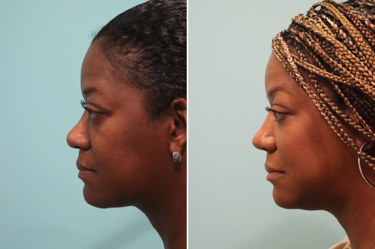 Before and after Rhinoplasty by Dr. Shervin Naderi, Patient 28191