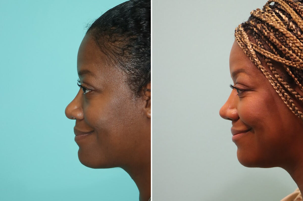 Before and after Rhinoplasty by Dr. Shervin Naderi, Patient 28191