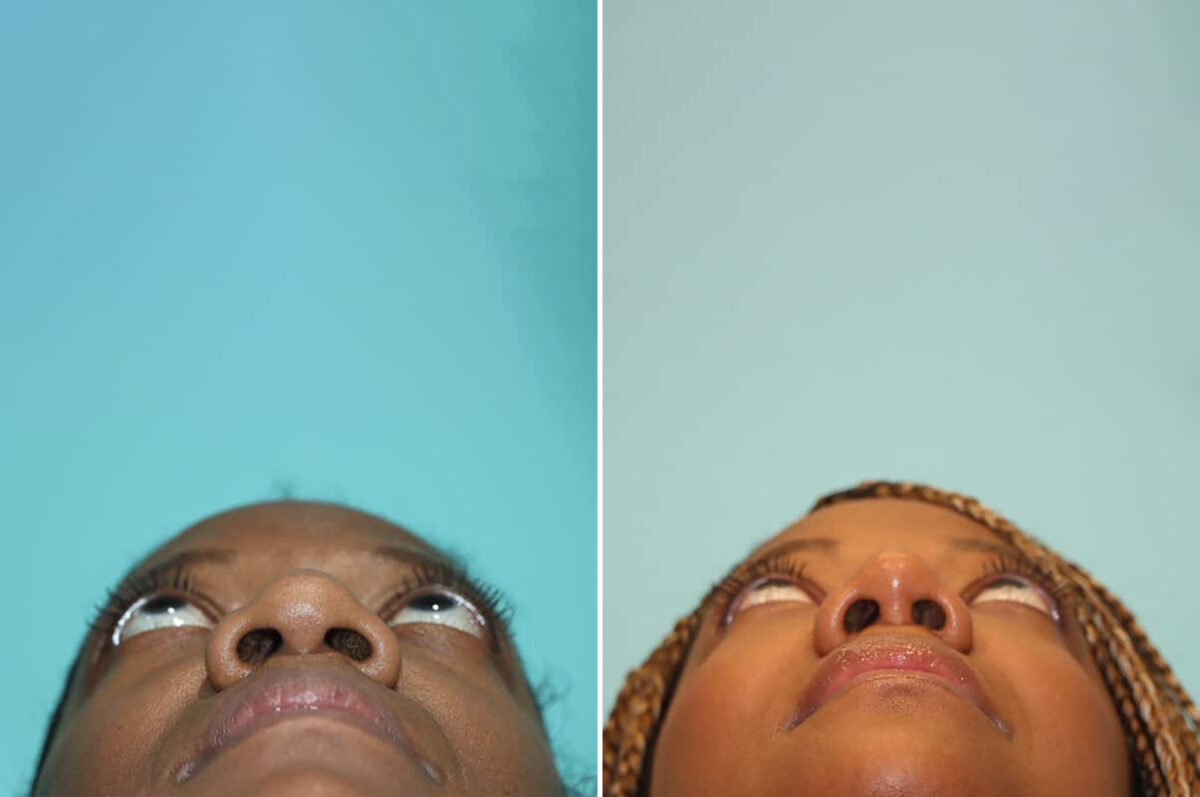 Before and after Rhinoplasty by Dr. Shervin Naderi, Patient 28191