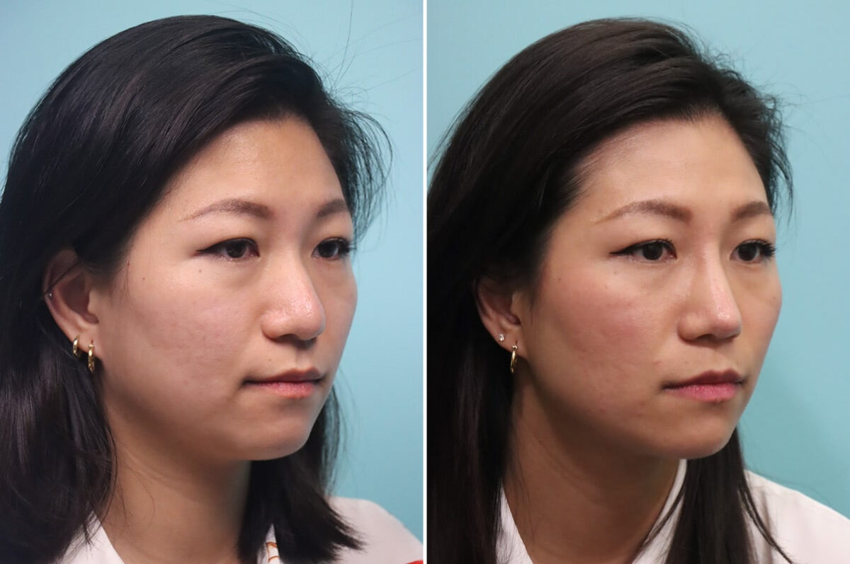 Before and after Rhinoplasty by Dr. Shervin Naderi, Patient 30042