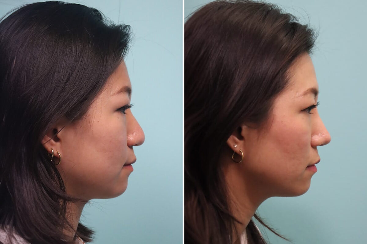 Before and after Rhinoplasty by Dr. Shervin Naderi, Patient 30042