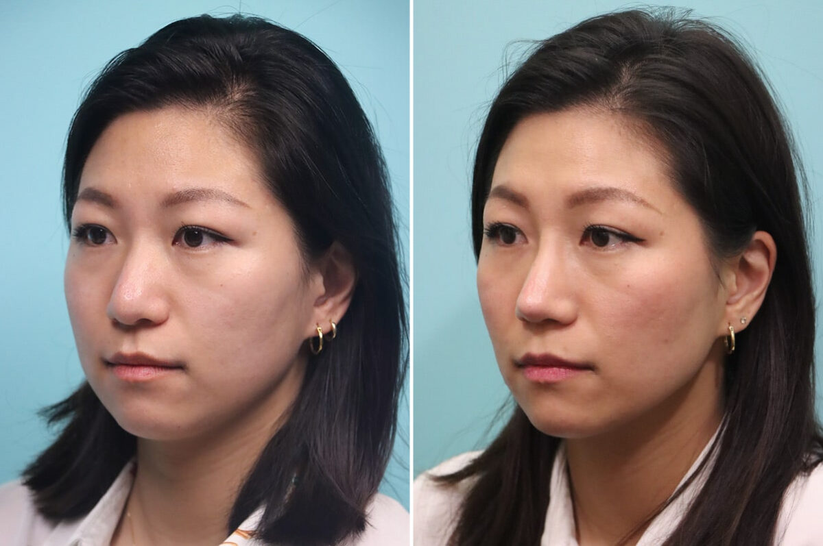 Before and after Rhinoplasty by Dr. Shervin Naderi, Patient 30042