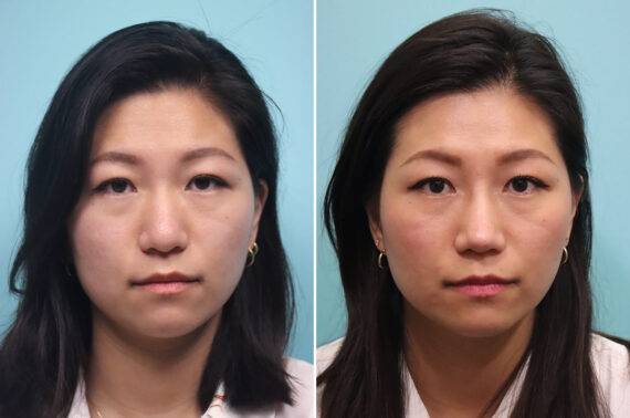 Before and after Rhinoplasty by Dr. Shervin Naderi, Patient 30042