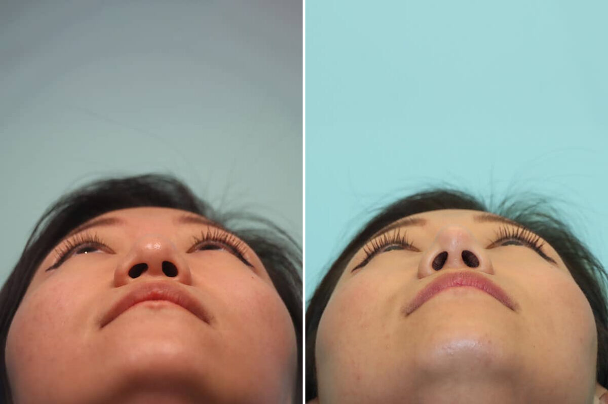 Before and after Rhinoplasty by Dr. Shervin Naderi, Patient 30042