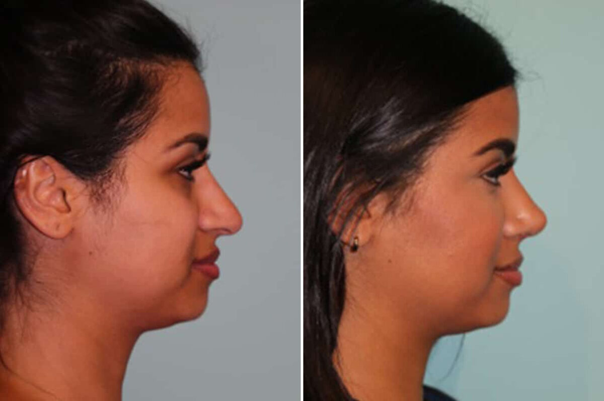 Before and after Rhinoplasty by Dr. Shervin Naderi, Patient 30064