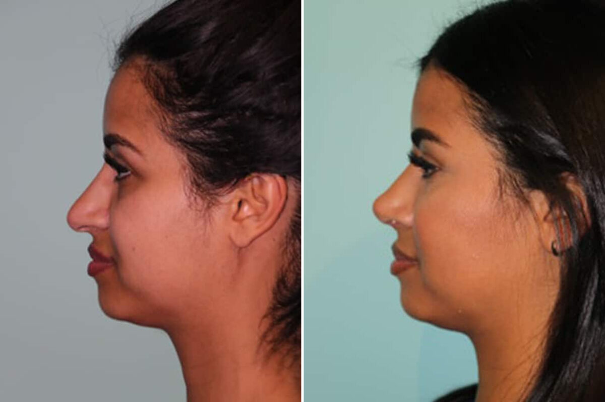 Before and after Rhinoplasty by Dr. Shervin Naderi, Patient 30064