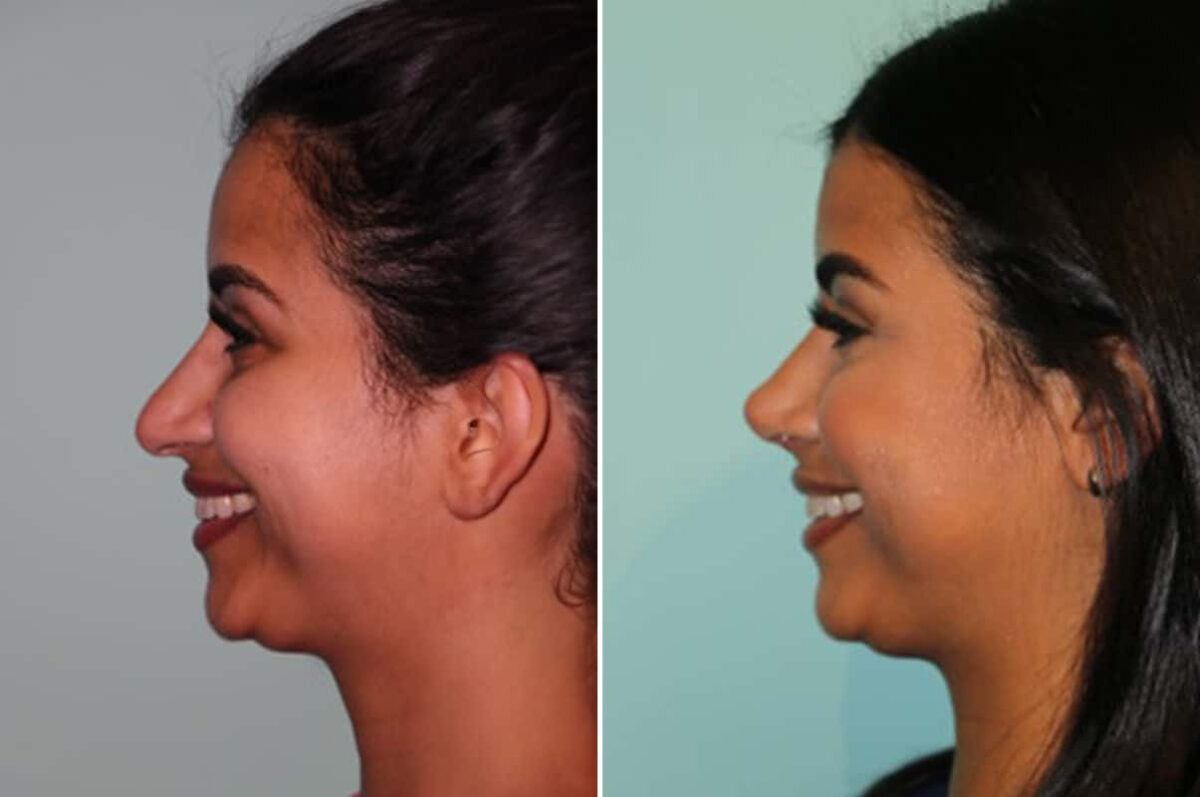 Before and after Rhinoplasty by Dr. Shervin Naderi, Patient 30064