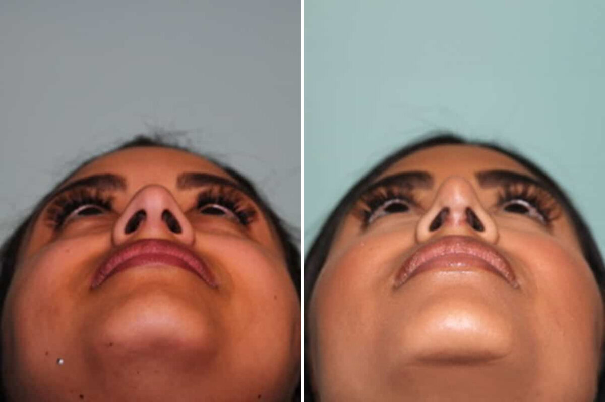 Before and after Rhinoplasty by Dr. Shervin Naderi, Patient 30064