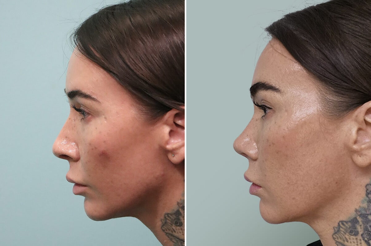 Before and after Rhinoplasty by Dr. Shervin Naderi, Patient 30123