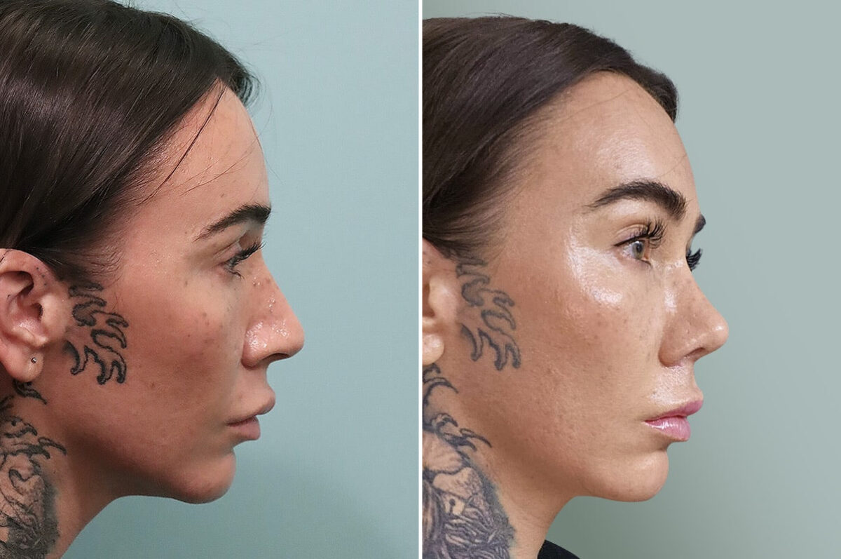 Before and after Rhinoplasty by Dr. Shervin Naderi, Patient 30123