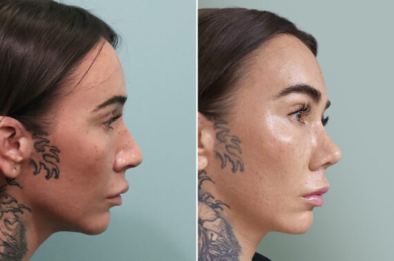 Before and after Rhinoplasty by Dr. Shervin Naderi, Patient 30123