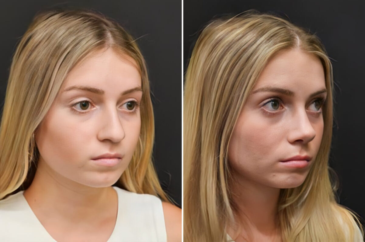 Before and after Rhinoplasty by Dr. Shervin Naderi, Patient 30130