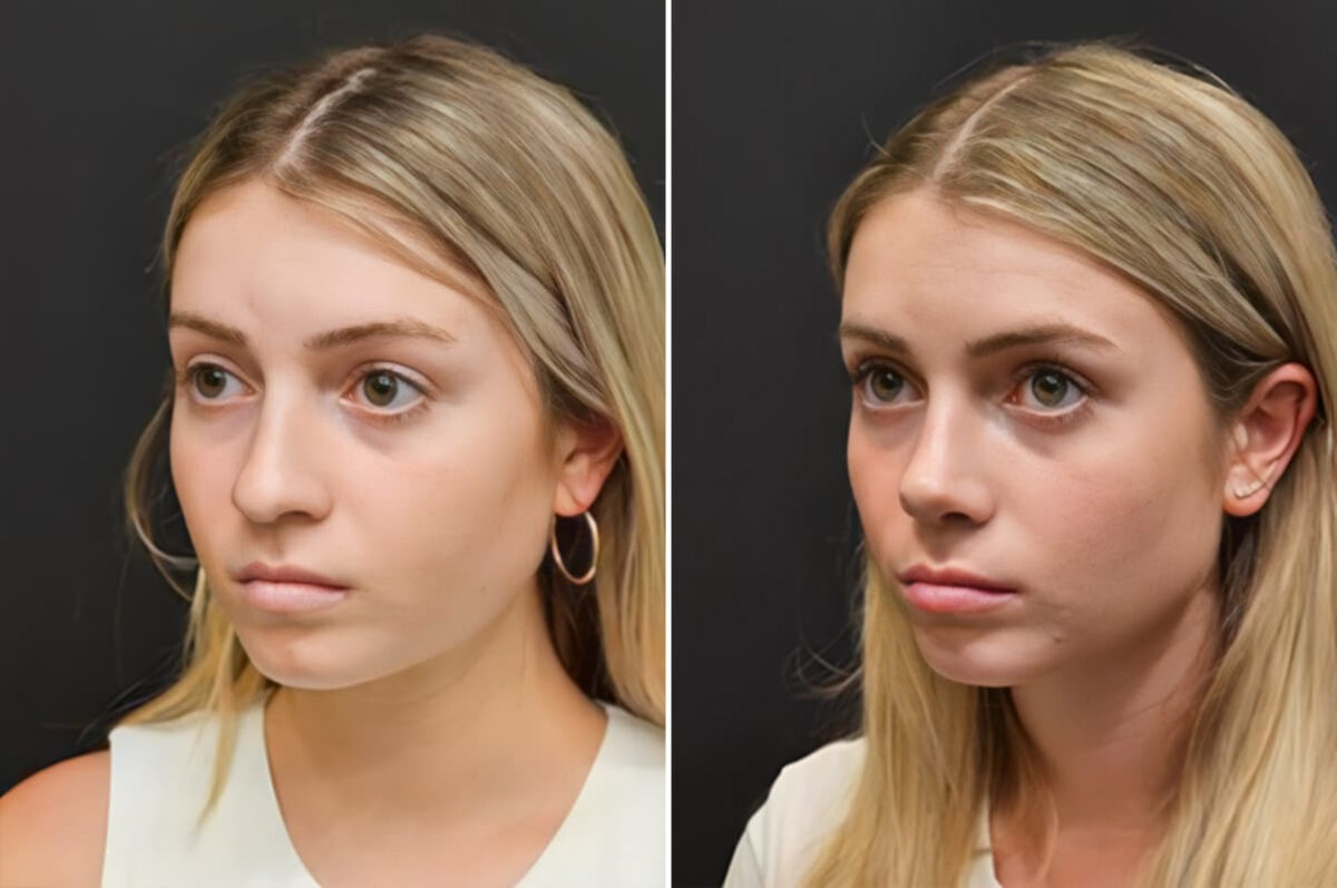 Before and after Rhinoplasty by Dr. Shervin Naderi, Patient 30130