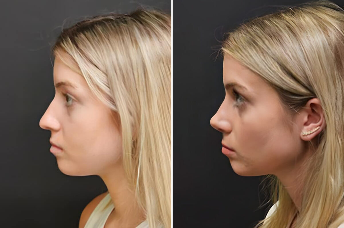 Before and after Rhinoplasty by Dr. Shervin Naderi, Patient 30130