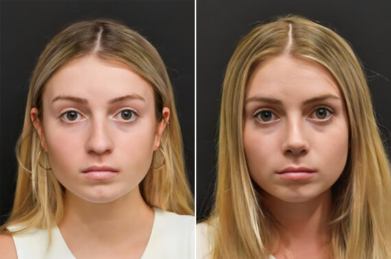 Before and after Rhinoplasty by Dr. Shervin Naderi, Patient 30130