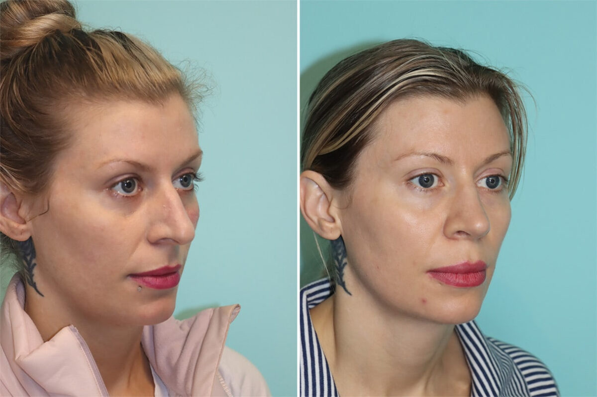 Before and after Rhinoplasty by Dr. Shervin Naderi, Patient 36477