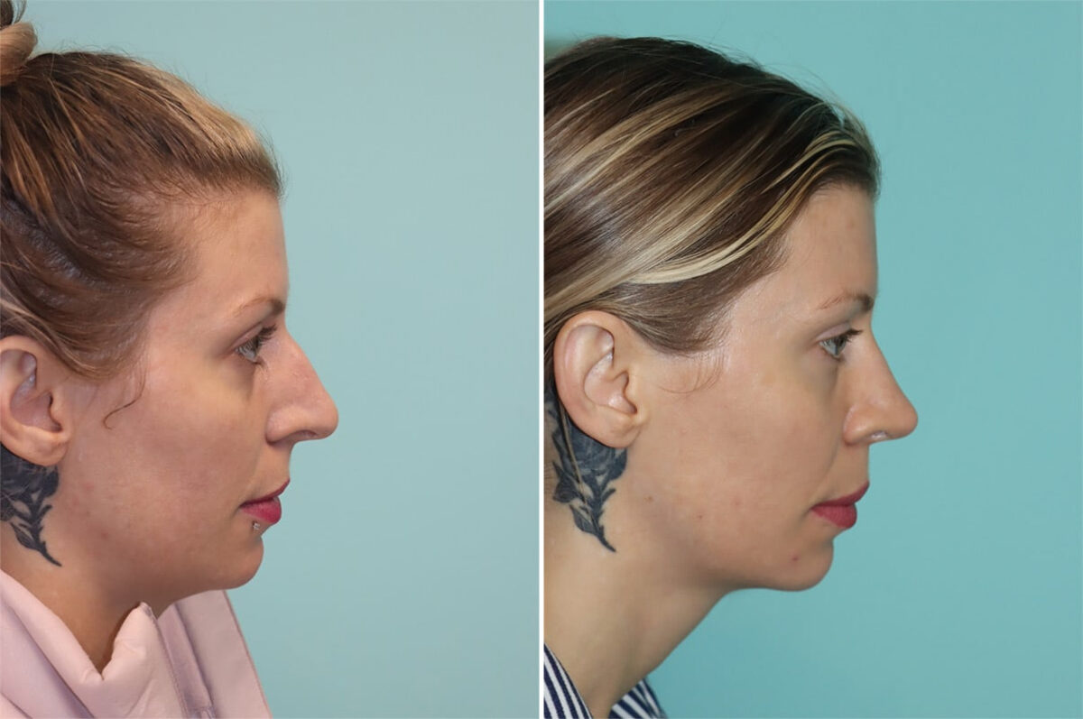Before and after Rhinoplasty by Dr. Shervin Naderi, Patient 36477