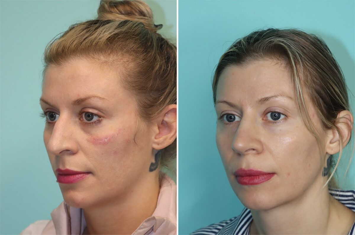 Before and after Rhinoplasty by Dr. Shervin Naderi, Patient 36477