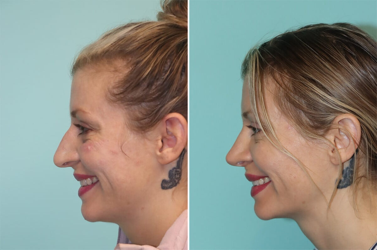 Before and after Rhinoplasty by Dr. Shervin Naderi, Patient 36477