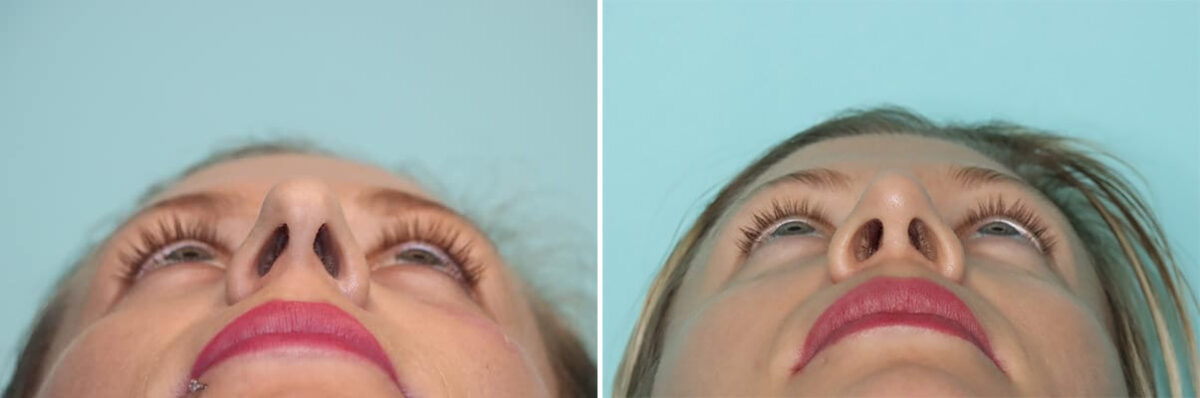 Before and after Rhinoplasty by Dr. Shervin Naderi, Patient 36477